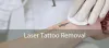 Laser Tattoo Removal 