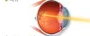 Laser Treatment for Diabetic Retinopathy: What to Expect?