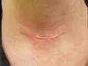 Scar Removal Kelowna BC – Healthpointlaser