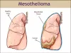 Learn About Mesothelioma and Get the Help You Deserve