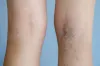 veintreatmentclinic01 [licensed for non-commercial use only] / What Is The Process Of Vein Treatment