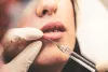 Lip Fillers Cardiff
