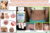 10 Natural Remedies for Lichen Planus - Herbal Care Products