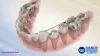 What Are Braces And What Do They Do?