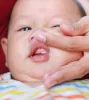 Lip Tie In Babies And Toddlers: Treatments And Symptoms - MyLondonDentist