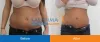 lipo.jpg