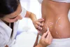 Liposuction Treatment in Delhi | Skintillate Clinic