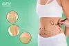 Everything You Need to Know About Liposuction Therapy?
