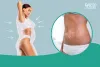 Things You Should Before Going for a Liposuction Therapy
