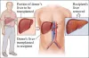 Liver Transplant In India | Liver Transplant cost in India