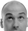 Best Hair Transplant Surgeon in Delhi | Hair Transplant Surgery 