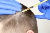 Best Hair Loss Treatment Clinic in Gurgaon