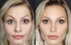 BOTOX 101: Everything You Need to Know About Botox