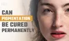 Can Pigmentation Be Cured Permanently - Luxury Aestheticclinic blog
