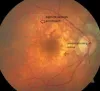 Macular Degeneration in Sarasota | Chris Stelton, MD Retina Specialist