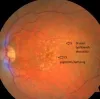 Macular Degeneration in Sarasota | Chris Stelton, MD Retina Specialist