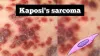 What Is Kaposi’s Sarcoma Cancer TYPES OF KAPOSI’S SARCOMA CANCER, CAUSES AND SYMPTOMS OF KAPOSI’S SARCOMA