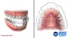 Make Your Smile Awesome With The Best Treatment Of Invisalign