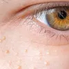 Milia Treatment in Dubai, Abu Dhabi &amp; Sharjah | Cost of Milia