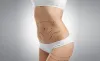 What is a Mini Tummy Tuck?
