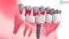 Affordable Dental Implant Arkansas, Implants For Dentures Cost Arkansas, Dental dentures Arkansas, Dentures Teeth Arkansas, Overdenture Implants Arkansas,