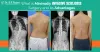 What is Minimally Invasive Scoliosis Surgery And Its Advantages