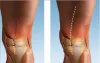 Hip Replacement Surgeon in Hyderabad |Best Hip Replacement Hospital 