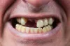 Why Replace Missing Teeth With Dental Implants? | Ban R Barbat | Township, Michigan