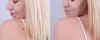 Small or Large Skin Mole Removal in Edmonton 