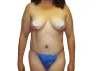 Mommy Makeover Houston, TX | Cosmetic Surgery | Liposuction