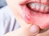 Ayurvedic Treatment for Mouth Ulcers |