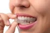What You Should Not Miss While Consulting The Dentist For Dentures? | What are the Types of Mouthguards Available?