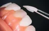 Why People Choose Dental Implants?