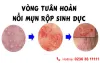  [Đà Nẵng] Mụn rộp sinh dục có chữa được không? Phương pháp điều trị tối ưu 