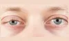 What's Happening: The Weakening of Eye Muscles Explained