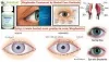 Natural Remedies for Blepharitis | Natural Treatment for Blepharitis - Herbal Care Products