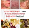 Itchy, Red Bumps? These Natural Treatments for Folliculitis Can Help! - Natural Health News