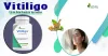 Vitiligo Diet and Remedies