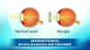 Nearsightedness: Myopia Diagnosis And Treatment - DLEI