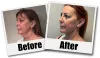 Best Neck Lift Seattle | Best Plastic Surgery Seattle