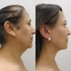 How Much Does a Neck Liposuction Cost - Premiere Surgical Art