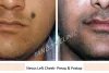 Mole Removal in Punjabi Bagh, Mole Removal in Paschim Vihar