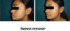 Best Mole Removal in Nangloi - Dr Ashok Tandon