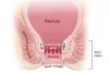 Types of Anal Cancer
