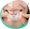 Dental Night Guards | Night Guards in SE Calgary - Galaxy Dental