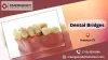 Dental Bridges Houston TX - ImgPile