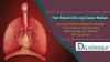 Non-Small Cell Lung Cancer Market