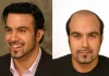 hair replacement