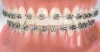 Orthodontic Treatment in Race Course| Clip Treatment in Coimbatore