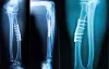 Intramedullary Implants